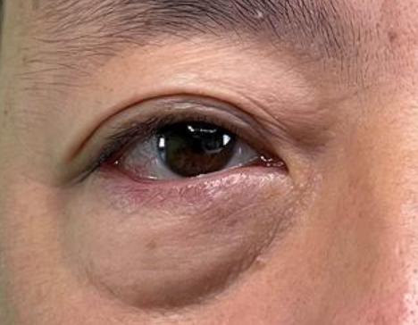 探秘小巷美容秘密，最新去眼袋最佳方法全解析