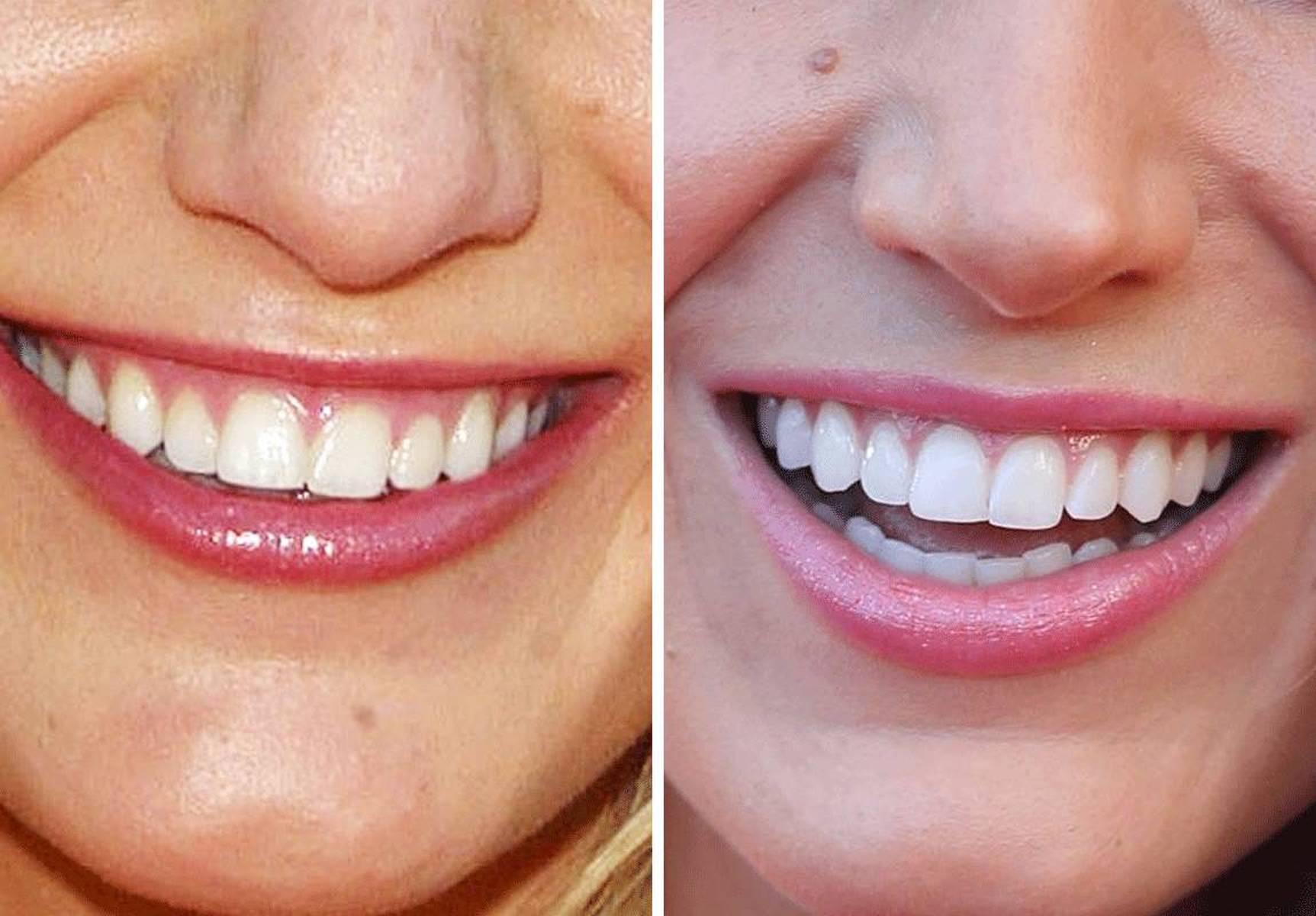 演员假牙安装与佩戴指南，从选择到佩戴的步骤全解析