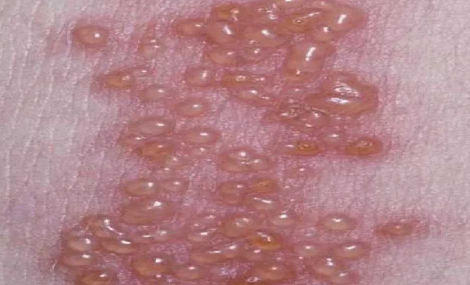 最新疱疹疗法观点论述与治疗效果解析