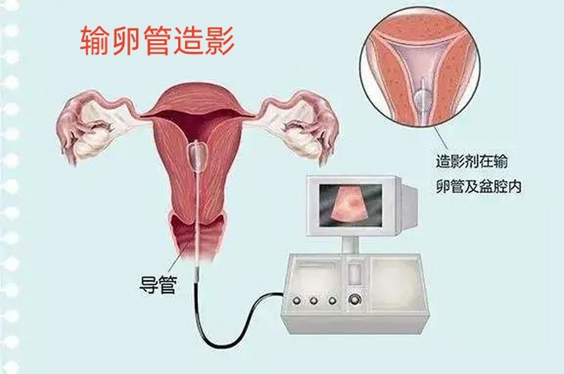 输卵管通液之旅，价格与爱的陪伴的奇妙经历