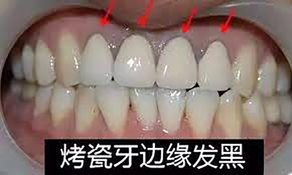 烤瓷牙价格探寻之旅,内心平静的冒险启程