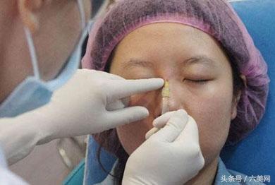 最新隆鼻材料,塑造完美鼻梁的秘密武器!👑