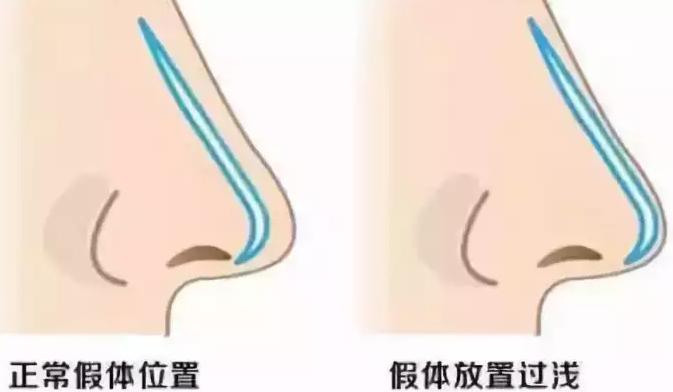 最新隆鼻材料,塑造完美鼻梁的秘密武器!👑