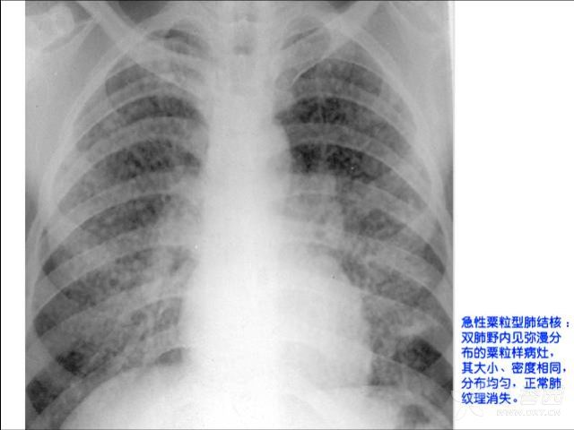 智能防护科技产品,守护最新肺炎名称下的健康防线
