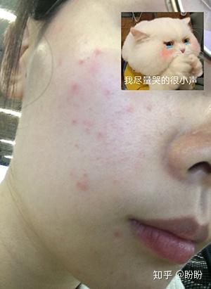 微针最新技术揭秘，三大革新重塑美容行业未来
